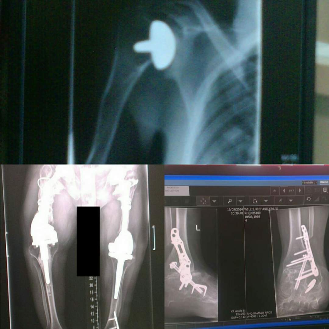 xrays